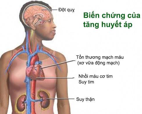 Bệnh cao huyết áp