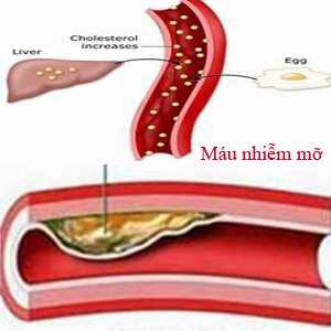 Tác dụng của tỏi đen điều trị căn bệnh máu nhiễm mỡ như thế nào?